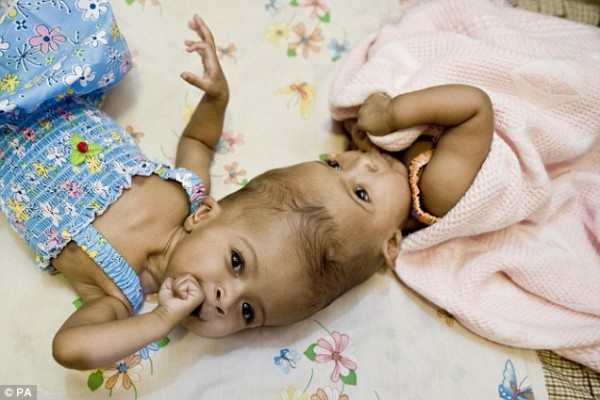 Conjoined Twins Beat Odds And Survive Surgical Separation