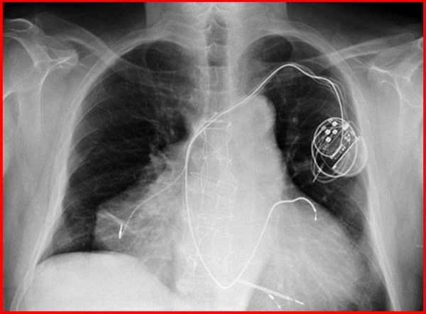 Man With 2-Hearts Suffers Double Heart-Attack And Survives!!