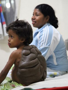 “Turtle Boy” Gets Surgery That Will Let Him Be A Normal Childhood