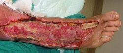 Woman Has Legs, Fingers Amputated From Flesh-Eating Bacteria