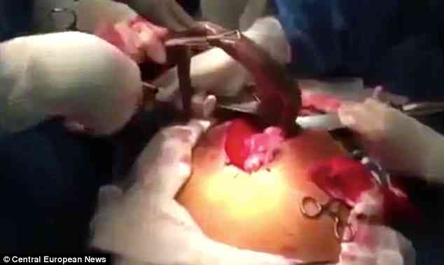 Man has a live fish removed from his intestines